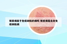 银屑病属于免疫缺陷的病吗 银屑病是自身免疫缺陷病