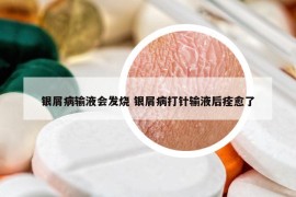 银屑病输液会发烧 银屑病打针输液后痊愈了