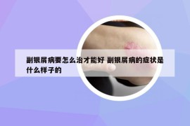 副银屑病要怎么治才能好 副银屑病的症状是什么样子的