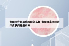 衡阳治疗银屑病医院怎么样 衡阳哪家医院治疗皮肤问题最有效