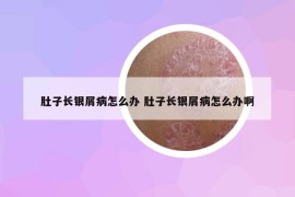 肚子长银屑病怎么办 肚子长银屑病怎么办啊