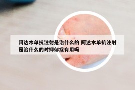 阿达木单抗注射是治什么的 阿达木单抗注射是治什么的对抑郁症有用吗