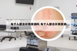 每个人都会长银屑病吗 每个人都会长银屑病吗图片