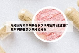 延边治疗银屑病要花多少钱才能好 延边治疗银屑病要花多少钱才能好呢