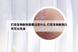打完生物制剂需要注意什么 打完生物制剂几天可以洗澡