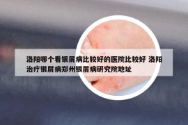 洛阳哪个看银屑病比较好的医院比较好 洛阳治疗银屑病郑州银屑病研究院地址