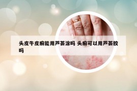 头皮牛皮癣能用芦荟涂吗 头癣可以用芦荟胶吗