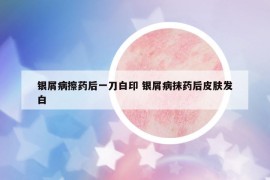 银屑病擦药后一刀白印 银屑病抹药后皮肤发白