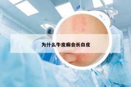 为什么牛皮癣会长白皮