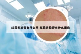 红霉素软膏有什么用 红霉素软膏有什么用途