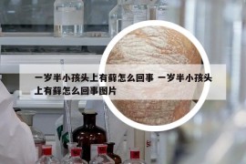 一岁半小孩头上有藓怎么回事 一岁半小孩头上有藓怎么回事图片