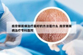 南京银屑病治疗最好的方法是什么 南京银屑病治疗专科医院