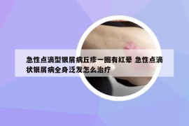 急性点滴型银屑病丘疹一圈有红晕 急性点滴状银屑病全身泛发怎么治疗