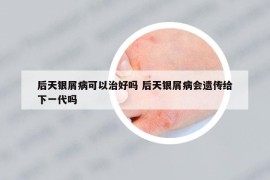 后天银屑病可以治好吗 后天银屑病会遗传给下一代吗