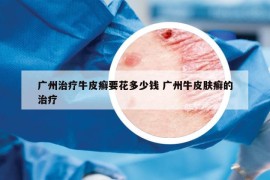 广州治疗牛皮癣要花多少钱 广州牛皮肤癣的治疗