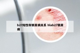 b27阳性和银屑病关系 hlab27银屑病