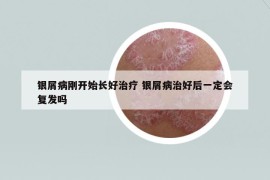 银屑病刚开始长好治疗 银屑病治好后一定会复发吗
