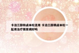 卡泊三醇和卤米松混用 卡泊三醇跟卤米松一起用治疗银屑病好吗
