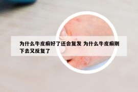 为什么牛皮癣好了还会复发 为什么牛皮癣刚下去又反复了
