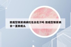 脓疱型银屑病病灶处会出汗吗 脓疱型银屑病会一直脓疱么