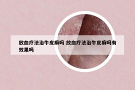 放血疗法治牛皮癣吗 放血疗法治牛皮癣吗有效果吗