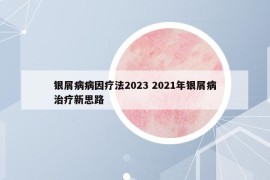 银屑病病因疗法2023 2021年银屑病治疗新思路