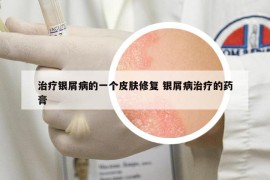 治疗银屑病的一个皮肤修复 银屑病治疗的药膏