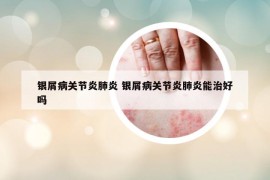 银屑病关节炎肺炎 银屑病关节炎肺炎能治好吗