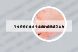 牛皮癣癣的症状 牛皮癣的症状该怎么办