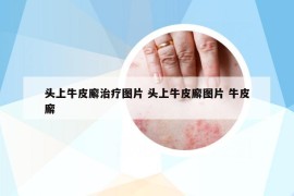 头上牛皮廨治疗图片 头上牛皮廨图片 牛皮廨