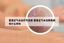 藿香正气水治疗牛皮癣 藿香正气水治银屑病有什么特效