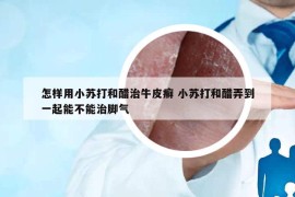 怎样用小苏打和醋治牛皮癣 小苏打和醋弄到一起能不能治脚气