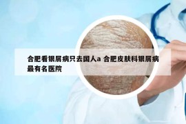 合肥看银屑病只去国人a 合肥皮肤科银屑病最有名医院