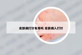 皮肤病打针有用吗 皮肤病人打针