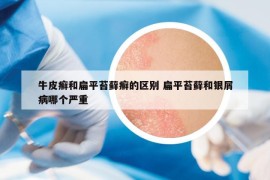 牛皮癣和扁平苔藓癣的区别 扁平苔藓和银屑病哪个严重