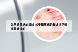 关于银屑病的描述 关于银屑病的叙述以下哪项是错误的