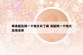 两条腿在同一个地方长了癣 双腿同一个地方出现皮疹