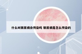 什么叫银屑病会传染吗 银屑病是怎么传染的