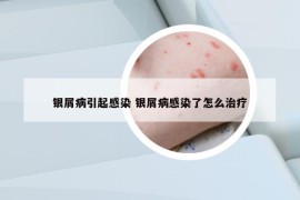 银屑病引起感染 银屑病感染了怎么治疗