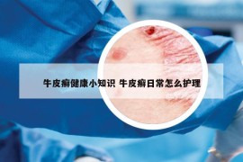 牛皮癣健康小知识 牛皮癣日常怎么护理