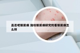 昌邑吧银屑病 潍坊银屑病研究院看银屑病怎么样