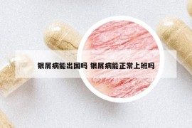 银屑病能出国吗 银屑病能正常上班吗