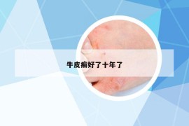 牛皮癣好了十年了