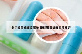 衡阳银屑病哪家医院 衡阳银屑病哪家医院好