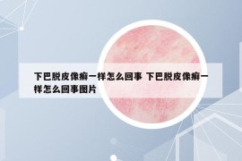 下巴脱皮像癣一样怎么回事 下巴脱皮像癣一样怎么回事图片