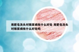 用肥皂洗头对银屑病有什么好处 用肥皂洗头对银屑病有什么好处吗