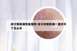 孩子银屑病恢复案例 孩子的银屑病一直好不了怎么办