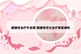 酮康唑治疗牛皮癣 酮康唑可以治疗银屑病吗