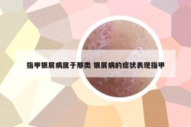指甲银屑病属于那类 银屑病的症状表现指甲