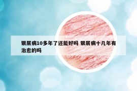 银屑病10多年了还能好吗 银屑病十几年有治愈的吗